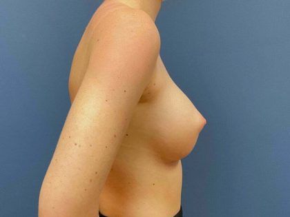 Breast Augmentation Before & After