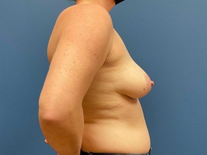 Breast Augmentation Before & After