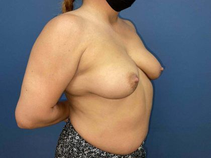 Breast Augmentation Before & After