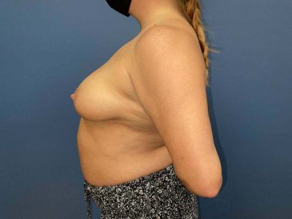 Breast Augmentation Before & After