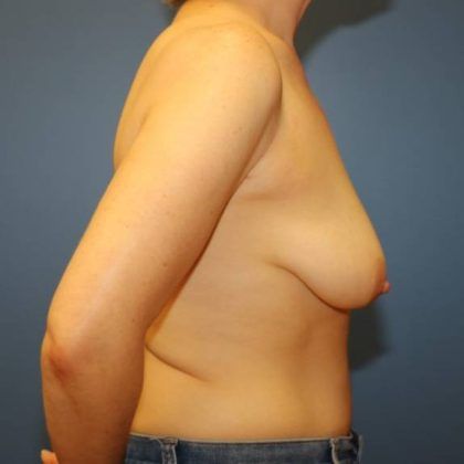 Breast Augmentation Before & After