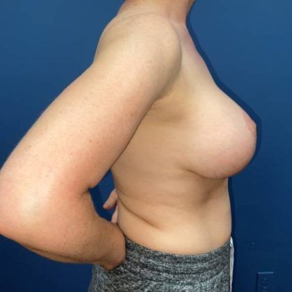 Breast Augmentation Before & After
