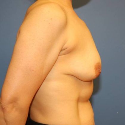 Breast Augmentation Before & After