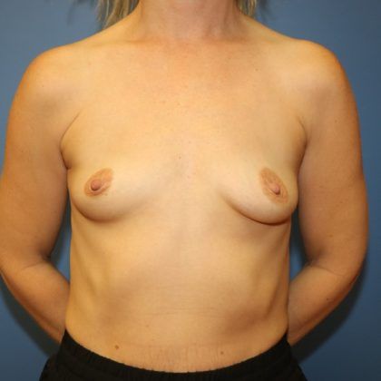 Breast Augmentation Before & After