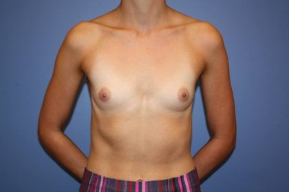 Breast Augmentation Before & After