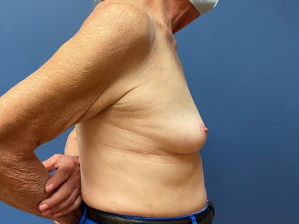 Breast Augmentation Before & After