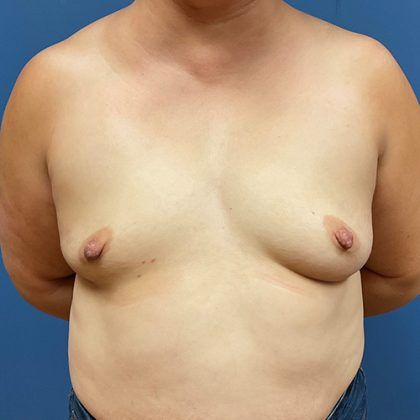 Breast Augmentation Before & After