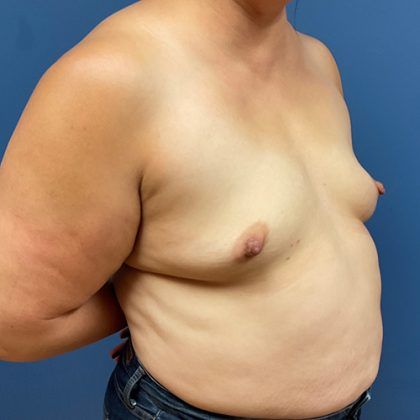 Breast Augmentation Before & After