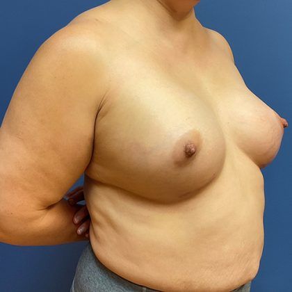 Breast Augmentation Before & After