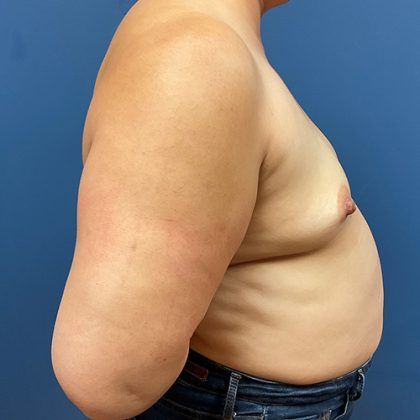 Breast Augmentation Before & After