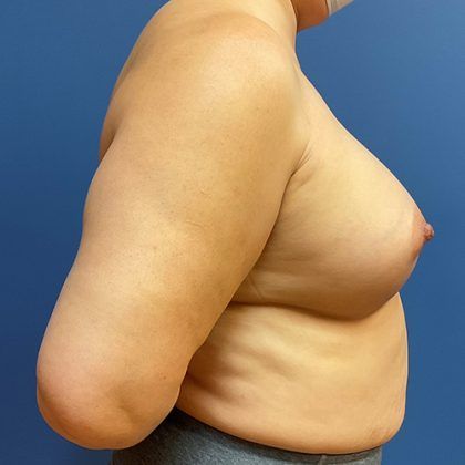 Breast Augmentation Before & After