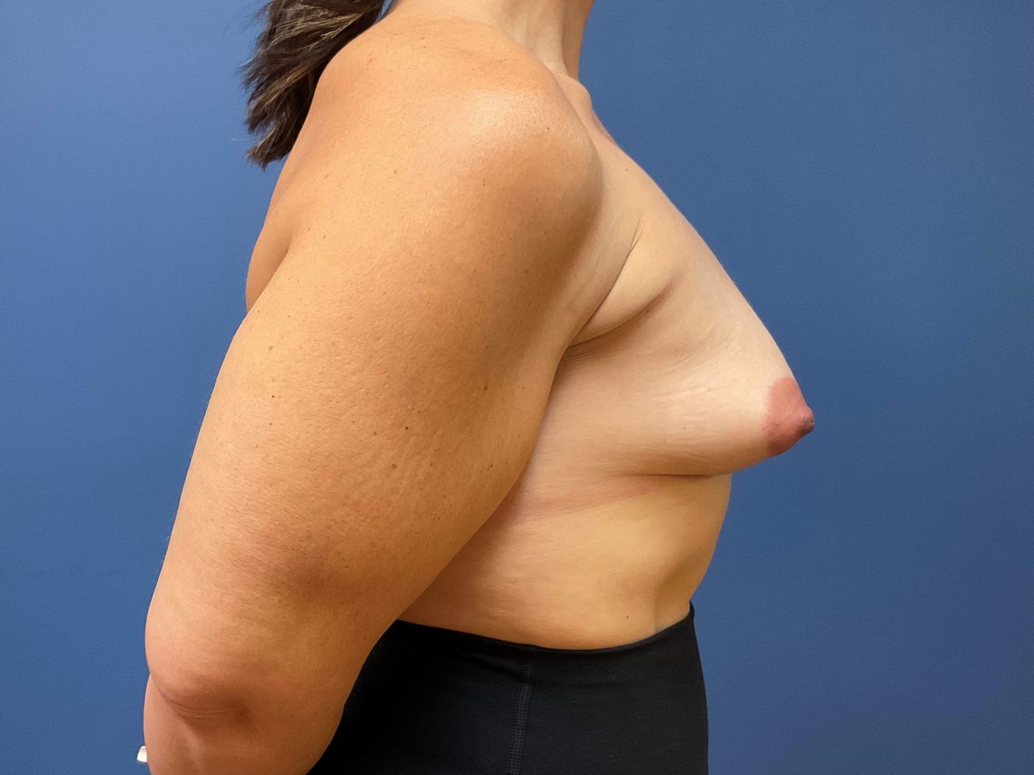Breast Augmentation Before & After