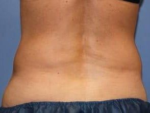 Mommy Makeover Before & After