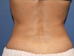 Mommy Makeover Before & After