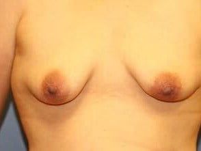 Mommy Makeover Before & After