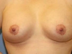 Mommy Makeover Before & After