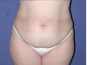 Mommy Makeover Before & After