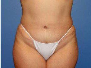 Mommy Makeover Before & After