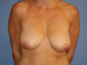 Mommy Makeover Before & After