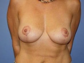 Mommy Makeover Before & After