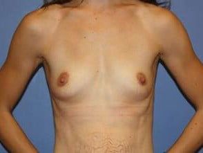 Mommy Makeover Before & After