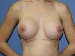 Mommy Makeover Before & After