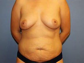 Mommy Makeover Before & After