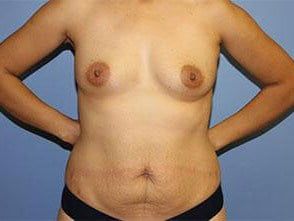 Mommy Makeover Before & After