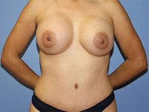 Mommy Makeover Before & After