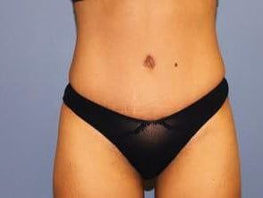 Mommy Makeover Before & After