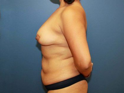 Mommy Makeover Before & After