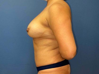 Mommy Makeover Before & After