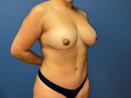 Mommy Makeover Before & After