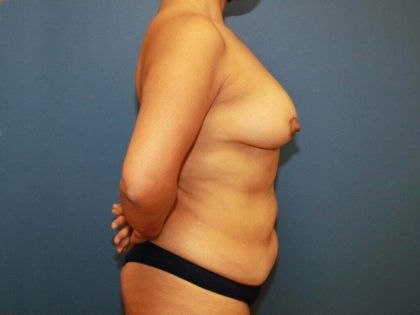 Mommy Makeover Before & After