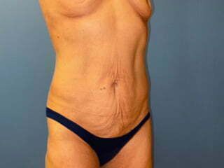 Mommy Makeover Before & After