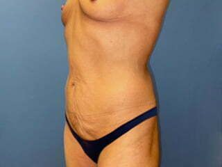 Mommy Makeover Before & After