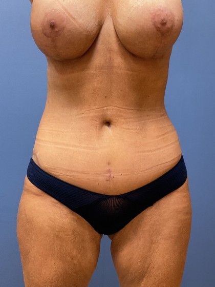 Mommy Makeover Before & After