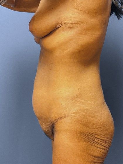 Mommy Makeover Before & After