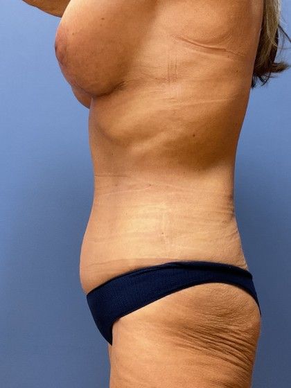 Mommy Makeover Before & After