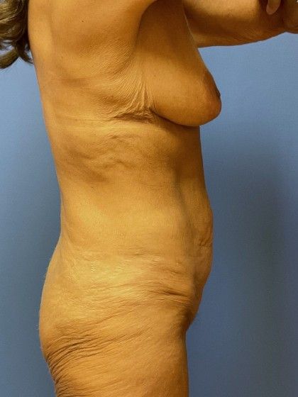 Mommy Makeover Before & After