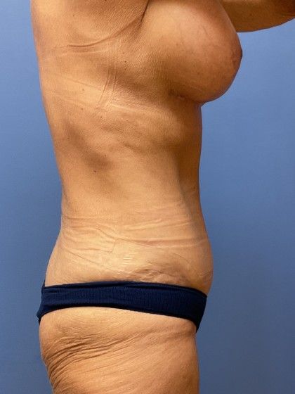 Mommy Makeover Before & After