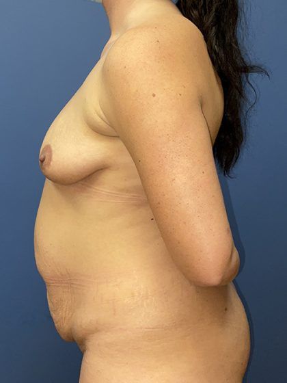 Mommy Makeover Before & After