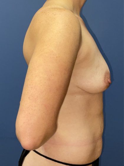 Mommy Makeover Before & After