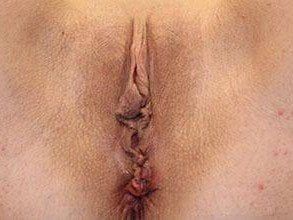 Vaginoplasty Before & After