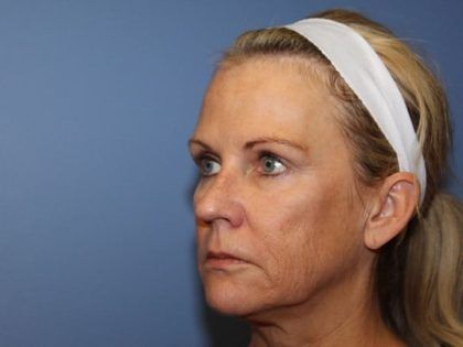 Facelift Before & After