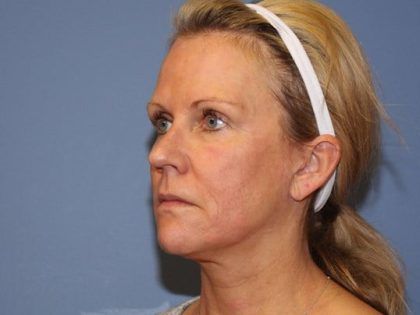 Facelift Before & After