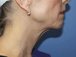 Facelift Before & After