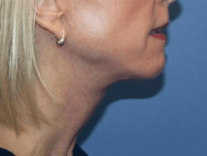 Facelift Before & After