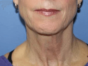 Facelift Before & After
