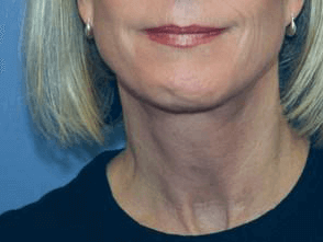 Facelift Before & After